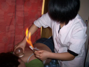 Fire Cupping Ancient Healing Technique